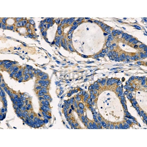 DOK3 Antibody - AF0600 at 1/100 staining Human colorectal cancer by IHC-P.