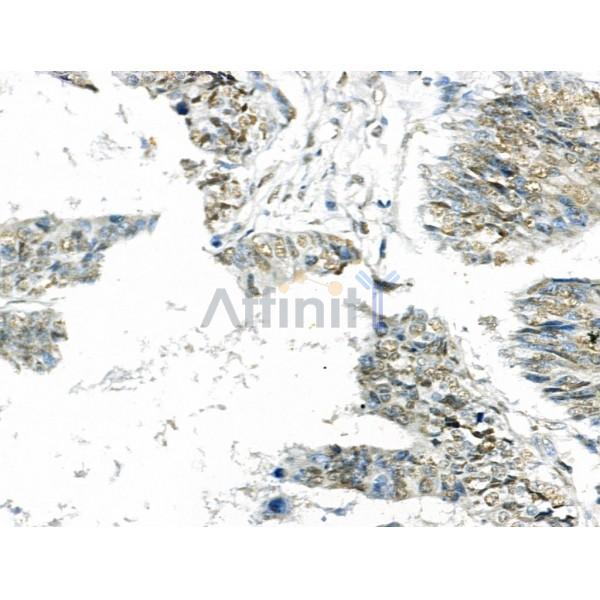 Histone H2B Antibody - AF0873 at 1/100 staining Human colorectal cancer and adjacent normal tissues by IHC-P.
