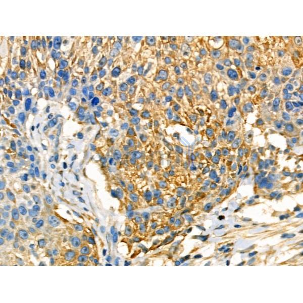 Phospho-FXYD1/PLM (Ser88/Ser89) Antibody - AF3787 at 1/100 staining Human ovarian cancer by IHC-P.