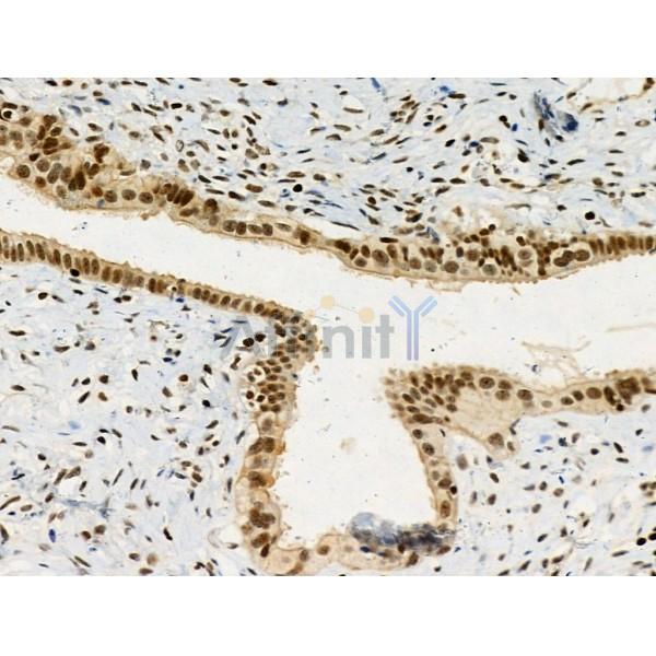 Phospho-RSK1 p90 (Thr348) Antibody - AF3811 at 1/100 staining Human ovarian cancer and adjacent normal tissues by IHC-P.