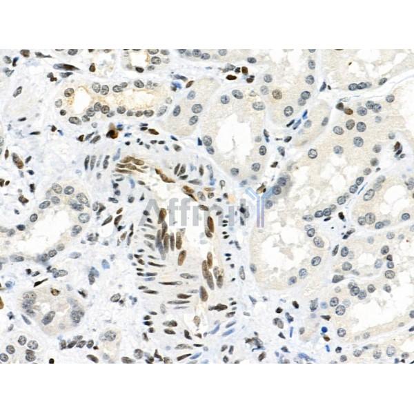 Phospho-RSK1 p90 (Thr348) Antibody - AF3811 at 1/100 staining Human kidney cancer and adjacent normal tissues by IHC-P.