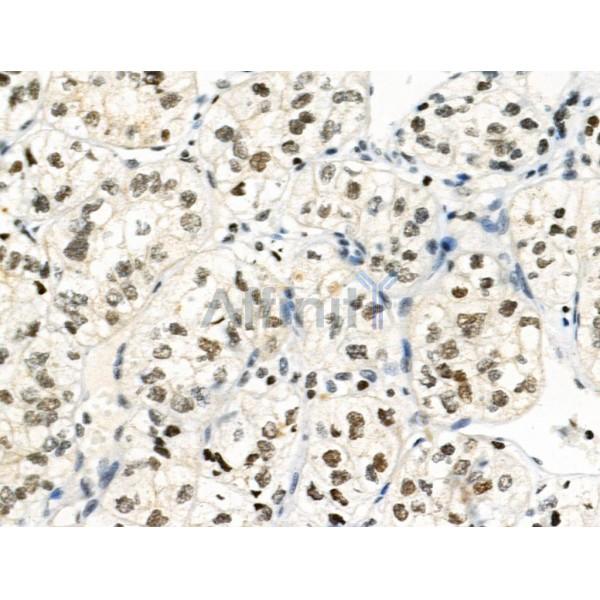 Phospho-RSK1 p90 (Thr348) Antibody - AF3811 at 1/100 staining Human kidney cancer by IHC-P.