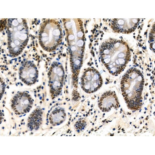 Phospho-AIRE (Ser156) Antibody - AF3841 at 1/100 staining Human gastric cancer and adjacent normal tissues by IHC-P.