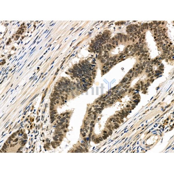 Phospho-AIRE (Ser156) Antibody - AF3841 at 1/100 staining Human colorectal cancer and adjacent normal tissues by IHC-P.