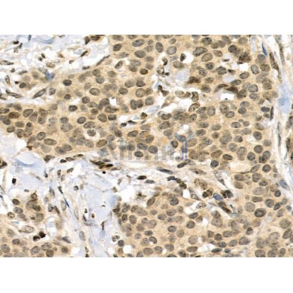 Phospho-AIRE (Ser156) Antibody - AF3841 at 1/100 staining Human mammary cancer by IHC-P.