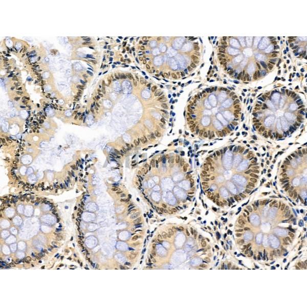 Phospho-AIRE (Ser156) Antibody - AF3841 at 1/100 staining Human esophageal cancer by IHC-P.