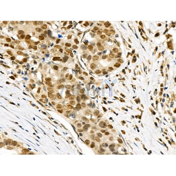 Phospho-AIRE (Ser156) Antibody - AF3841 at 1/100 staining Human gastric cancer by IHC-P.