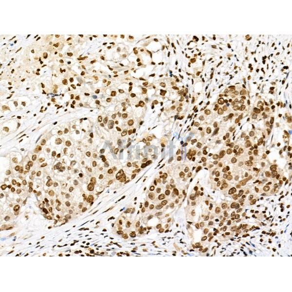Phospho-AIRE (Ser156) Antibody - AF3841 at 1/100 staining Human ovarian cancer by IHC-P.