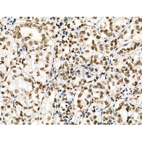 Phospho-AIRE (Ser156) Antibody - AF3841 at 1/100 staining Human kidney cancer by IHC-P.