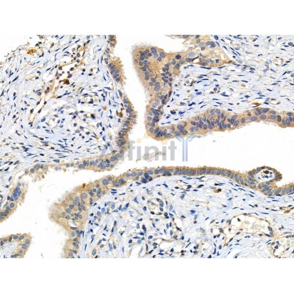 Phospho-MKK7 (Thr275) Antibody - AF3859 at 1/100 staining Human ovarian cancer and adjacent normal tissues by IHC-P.