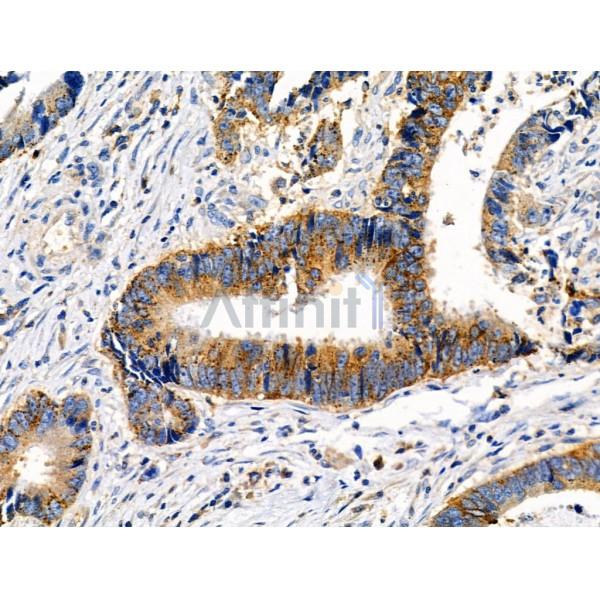 Phospho-MKK7 (Thr275) Antibody - AF3859 at 1/100 staining Human colorectal cancer by IHC-P.