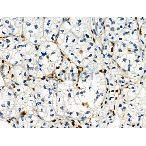 Phospho-Histone H3 (Ser28) Antibody - AF3868 at 1/100 staining Human kidney cancer by IHC-P.