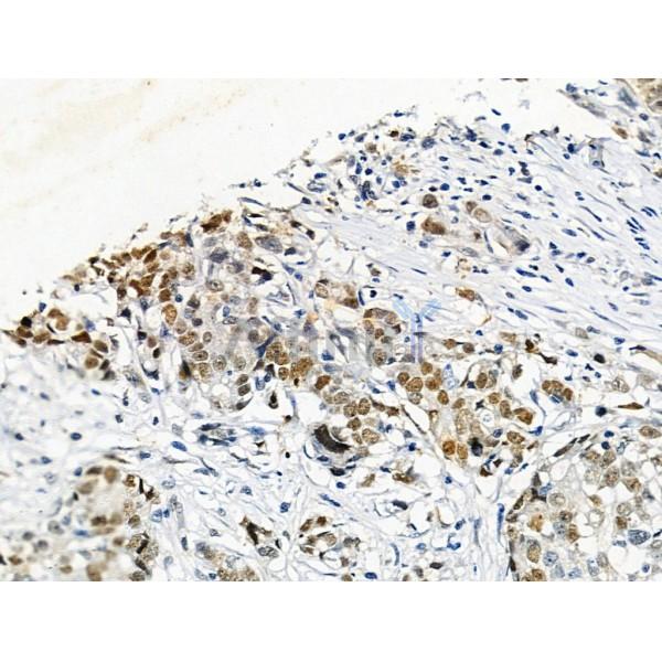 Phospho-Histone H3 (Ser28) Antibody - AF3868 at 1/100 staining Human gastric cancer by IHC-P.