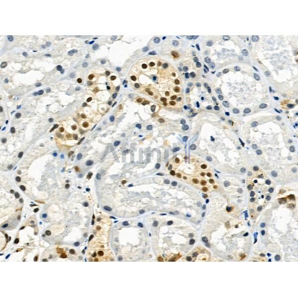 Phospho-Histone H3 (Ser28) Antibody - AF3868 at 1/100 staining Human kidney cancer and adjacent normal tissues by IHC-P.