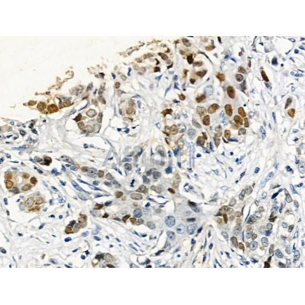 Phospho-p53 (Ser33) Antibody - AF3873 at 1/100 staining Human gastric cancer by IHC-P.
