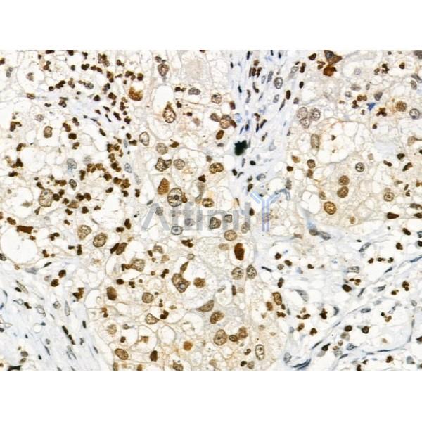 Phospho-p53 (Ser33) Antibody - AF3873 at 1/100 staining Human ovarian cancer by IHC-P.