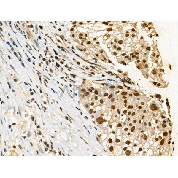 Phospho-p53 (Ser33) Antibody - AF3873 at 1/100 staining Human ovarian cancer by IHC-P.