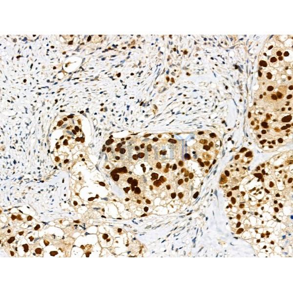 Phospho-MCM2 (Ser41) Antibody - AF3880 at 1/100 staining Human ovarian cancer by IHC-P.