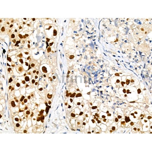 Phospho-MCM2 (Ser41) Antibody - AF3880 at 1/100 staining Human ovarian cancer by IHC-P.
