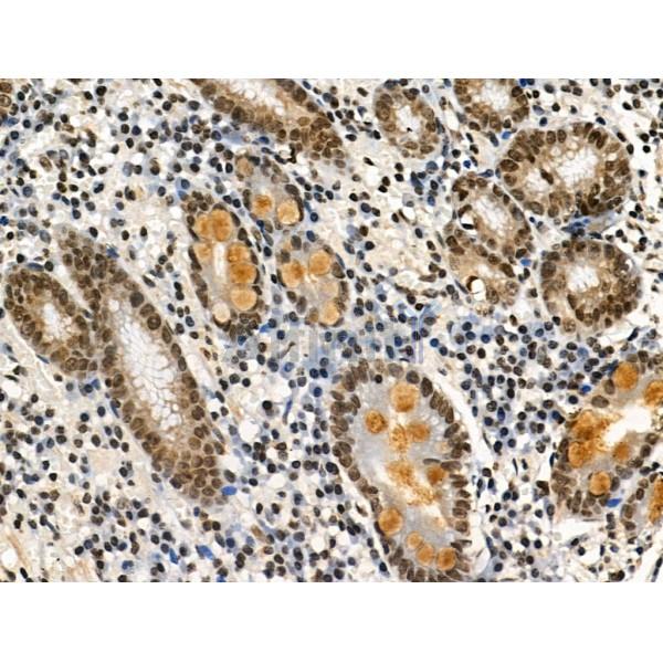 Phospho-LRRK2 (Ser910) Antibody - AF3887 at 1/100 staining Human gastric cancer by IHC-P.