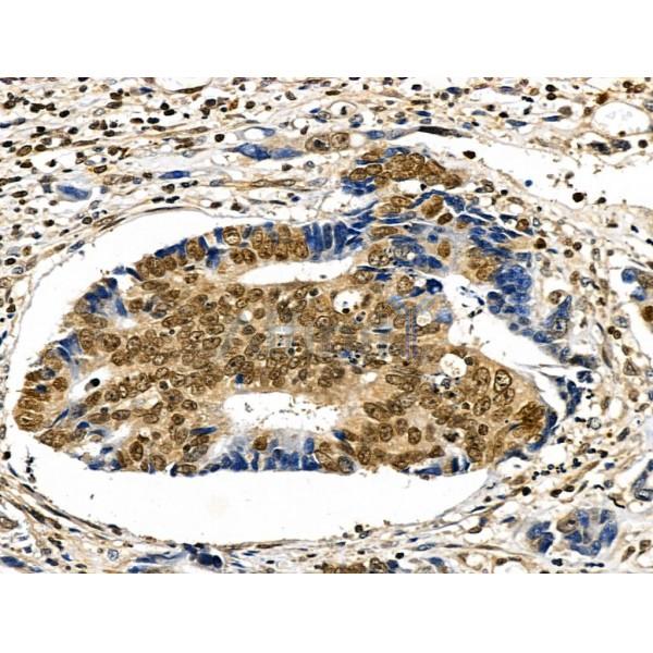 Phospho-LRRK2 (Ser910) Antibody - AF3887 at 1/100 staining Human colorectal cancer by IHC-P.