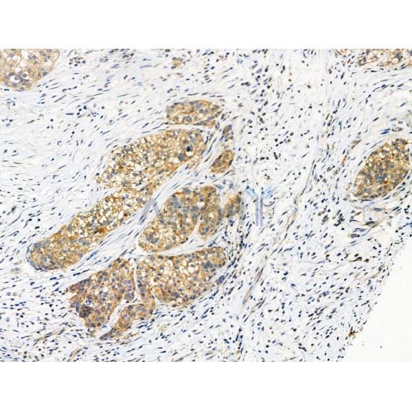 Phospho-Transferrin Receptor (Tyr20) Antibody - AF3896 at 1/100 staining Human ovarian cancer by IHC-P.