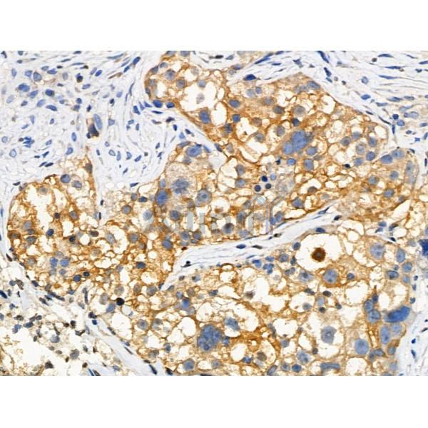 Phospho-MLKL (Thr349) Antibody - AF3904 at 1/100 staining Human ovarian cancer by IHC-P.