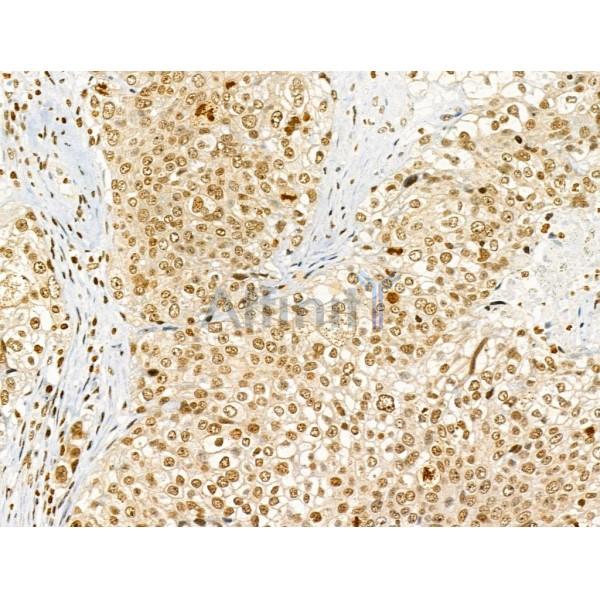 Phospho-ENSA (Ser67) Antibody - AF4381 at 1/100 staining Human pancreatic cancer by IHC-P.