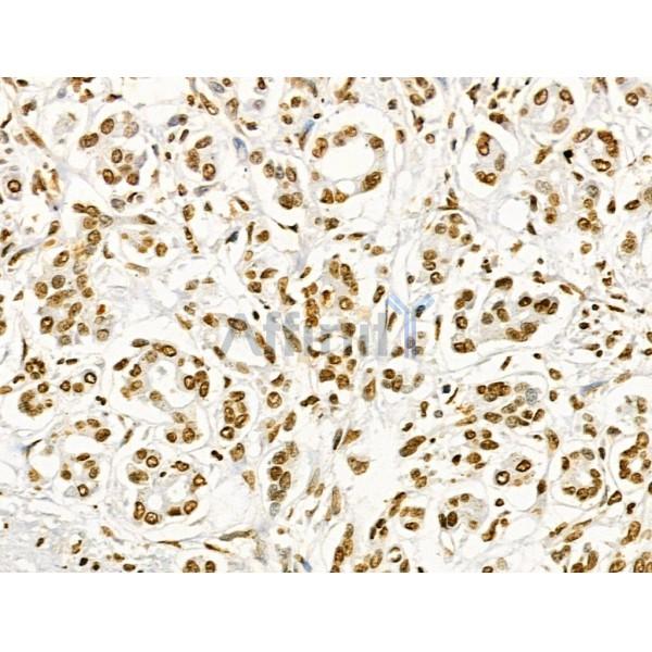 Phospho-ENSA (Ser67) Antibody - AF4381 at 1/100 staining Human pancreatic cancer and adjacent nomal tissues by IHC-P.