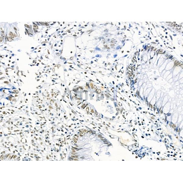 Phospho-ENSA (Ser67) Antibody - AF4381 at 1/100 staining Human colorectal cancer by IHC-P.