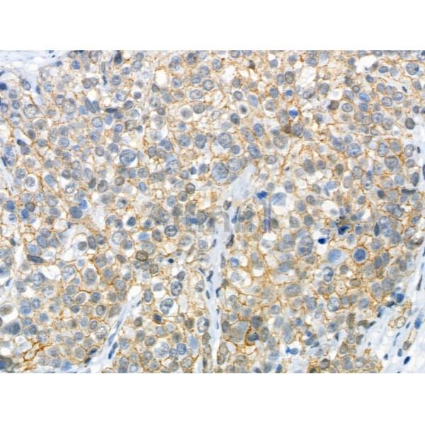 Phospho-Catenin 1 (Ser320) Antibody - AF4384 at 1/100 staining Human pancreatic cancer by IHC-P.