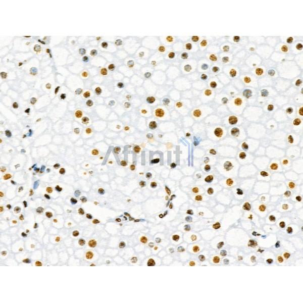 Phospho-SRF (Ser103) Antibody - AF4403 at 1/100 staining Human kidney cancer by IHC-P.