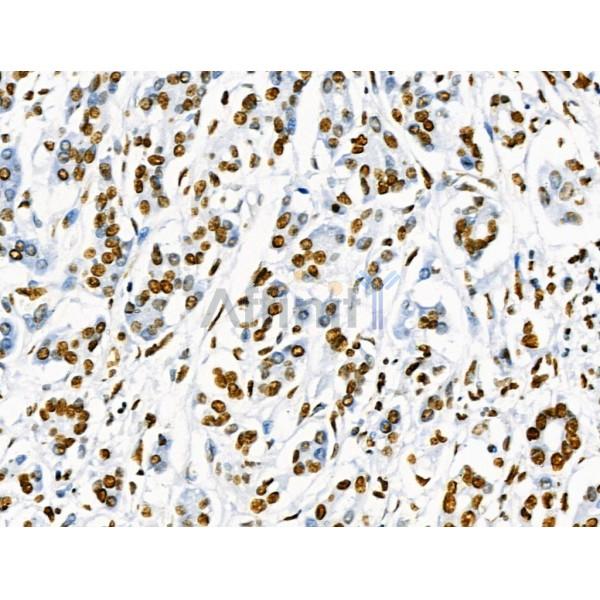 Phospho-SRF (Ser103) Antibody - AF4403 at 1/100 staining Human pancreatic cancer and adjacent nomal tissues by IHC-P.