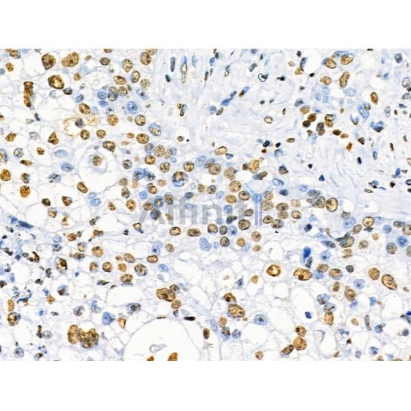 Phospho-SRF (Ser103) Antibody - AF4403 at 1/100 staining Human pancreatic cancer by IHC-P.