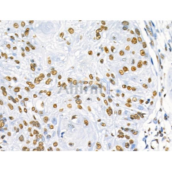 Phospho-SRF (Ser103) Antibody - AF4403 at 1/100 staining Human esophageal cancer by IHC-P.