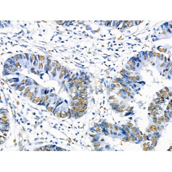 Phospho-SRF (Ser103) Antibody - AF4403 at 1/100 staining Human colorectal cancer by IHC-P.