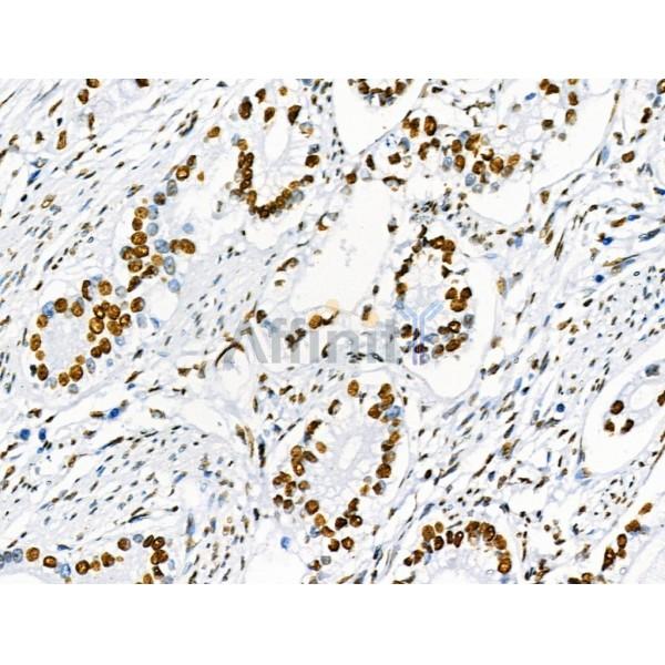 Phospho-SRF (Ser103) Antibody - AF4403 at 1/100 staining Human gastric cancer by IHC-P.