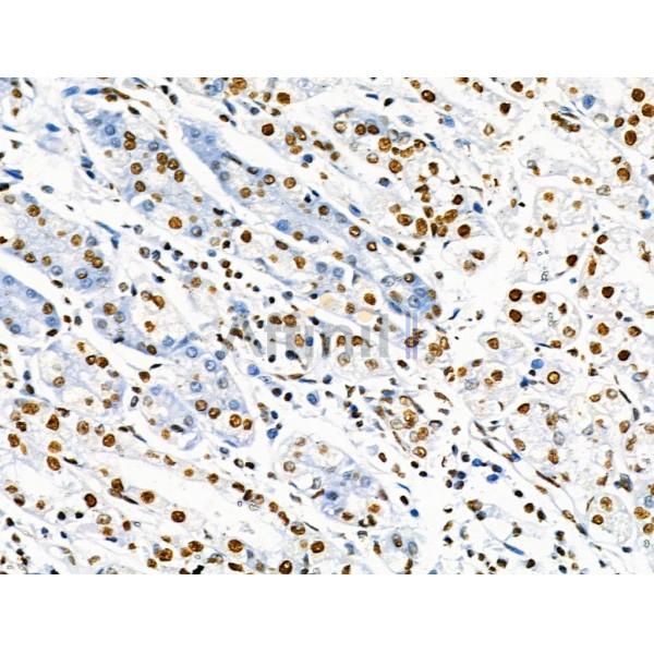 Phospho-SRF (Ser103) Antibody - AF4403 at 1/100 staining Human gastric cancer and adjacent normal tissues by IHC-P.