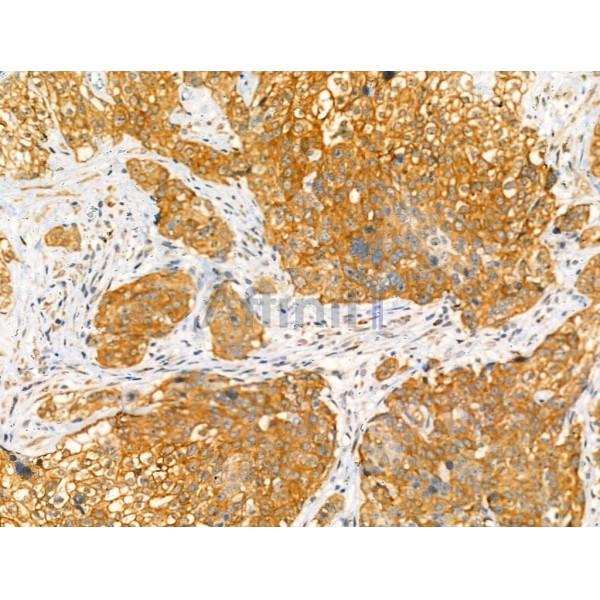 Phospho-NUR77 (Ser351) Antibody - AF4412 at 1/100 staining Human pancreatic cancer by IHC-P.