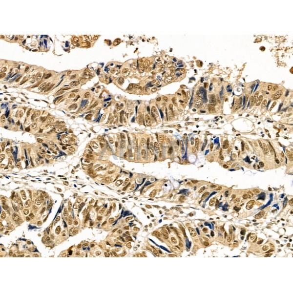 Phospho-Cyclin E1 (Ser73) Antibody - AF4413 at 1/100 staining Human colorectal cancer by IHC-P.