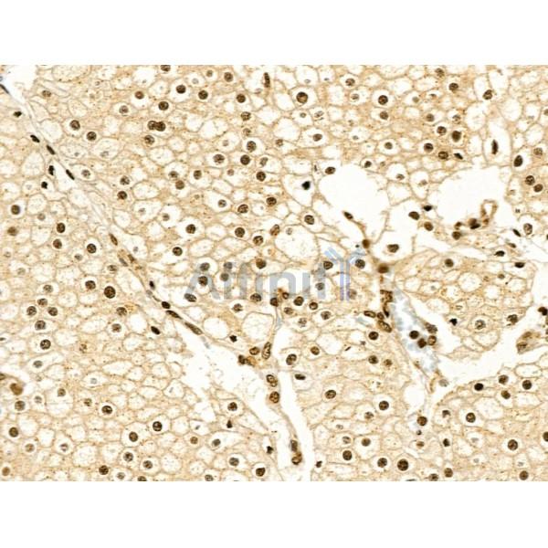 Phospho-Cyclin E1 (Ser73) Antibody - AF4413 at 1/100 staining Human kidney cancer by IHC-P.