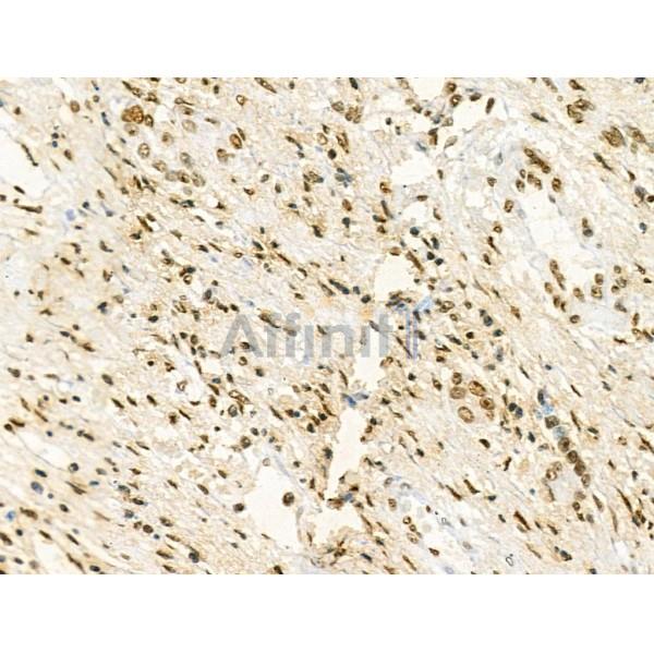 Phospho-IRF4 (Tyr122/Tyr125) Antibody - AF4476 at 1/100 staining Human liver cancer by IHC-P.