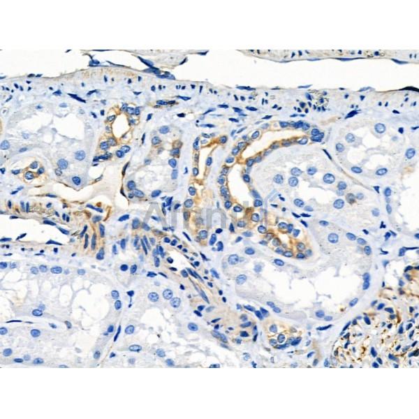 Phospho-NFAT1 (Ser326) Antibody - AF8011 at 1/100 staining Human kidney cancer and adjacent normal tissues by IHC-P.