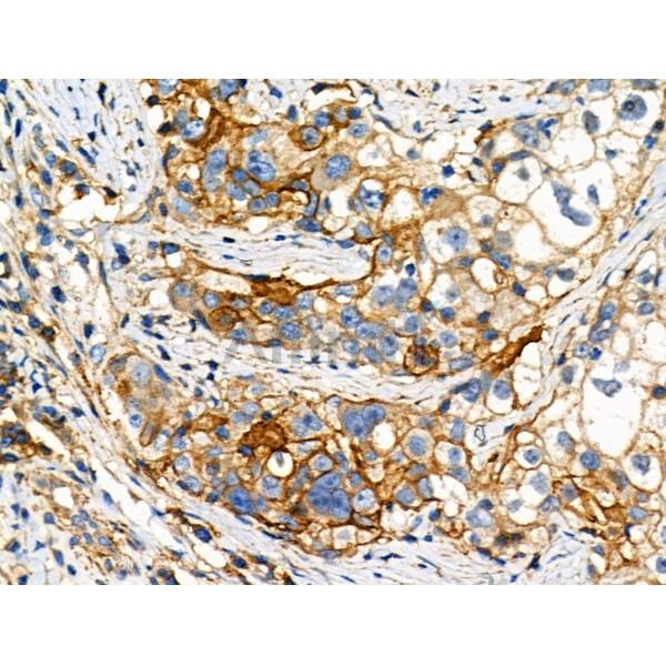 Phospho-NFAT2 (Ser294) Antibody - AF8012 at 1/100 staining Human ovarian cancer by IHC-P.