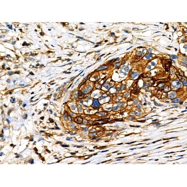Phospho-NFAT2 (Ser294) Antibody - AF8012 at 1/100 staining Human ovarian cancer by IHC-P.