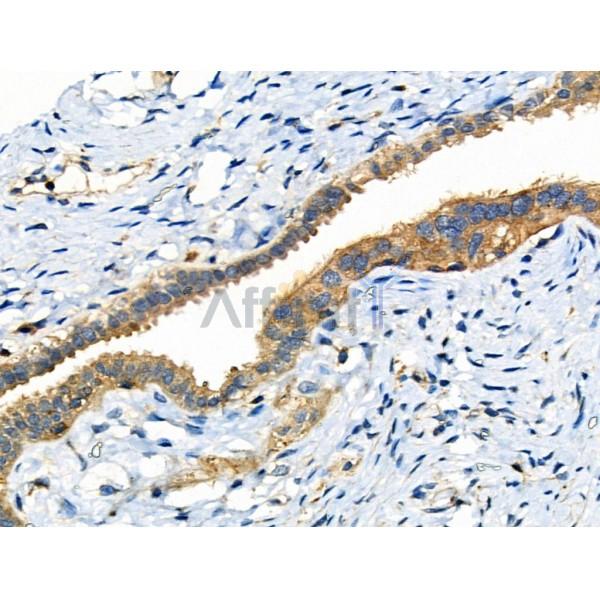 Phospho-NFAT2 (Ser294) Antibody - AF8012 at 1/100 staining Human ovarian cancer and adjacent normal tissues by IHC-P.
