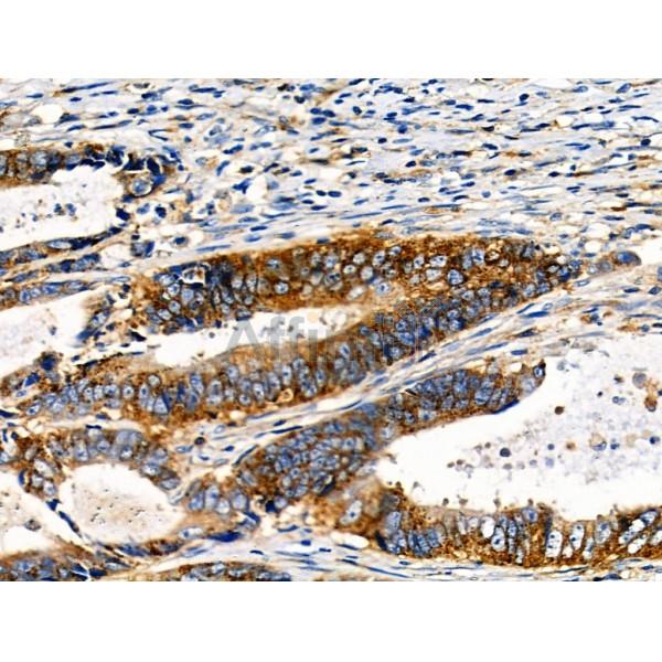 Phospho-NFAT2 (Ser294) Antibody - AF8012 at 1/100 staining Human colorectal cancer by IHC-P.
