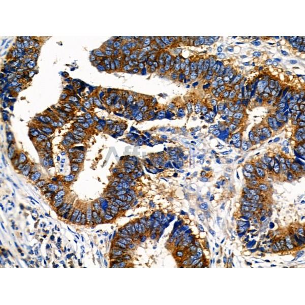 Phospho-NFAT2 (Ser294) Antibody - AF8012 at 1/100 staining Human colorectal cancer by IHC-P.