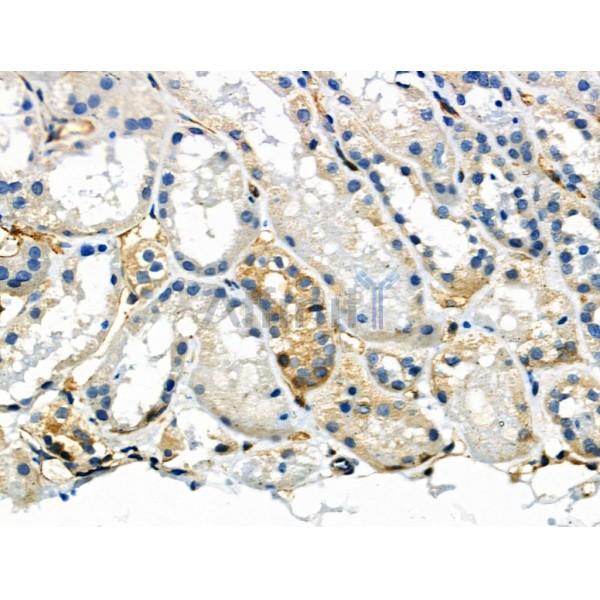 Phospho-NFAT2 (Ser294) Antibody - AF8012 at 1/100 staining Human kidney cancer and adjacent normal tissues by IHC-P.