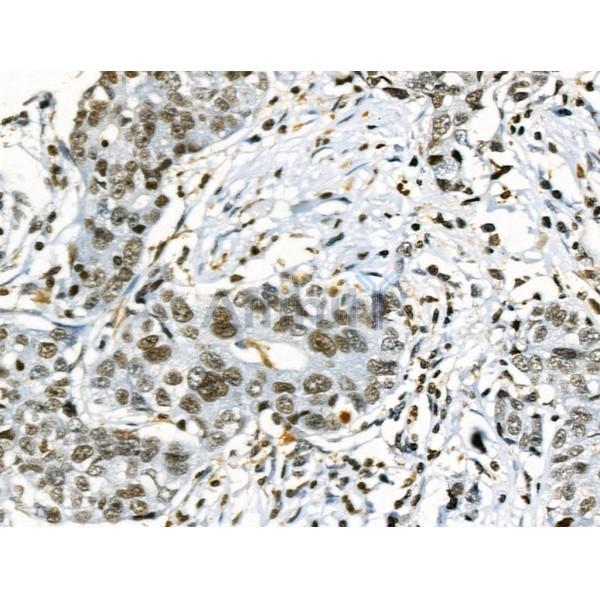 Phospho-TLK1 (Ser741) Antibody - AF8029 at 1/100 staining Human gastric cancer by IHC-P.